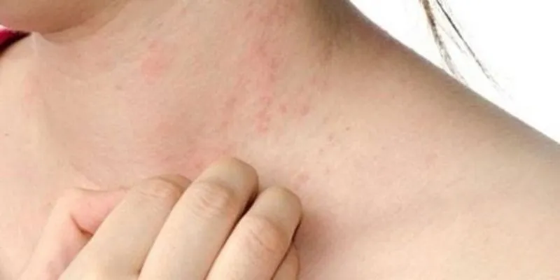 Dị ứng được biểu hiện như thế nào?