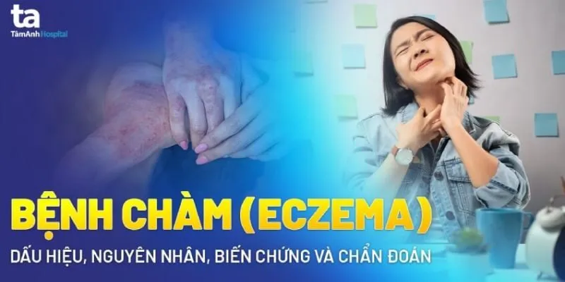 Chàm (eczema) – chẩn đoán và điều trị