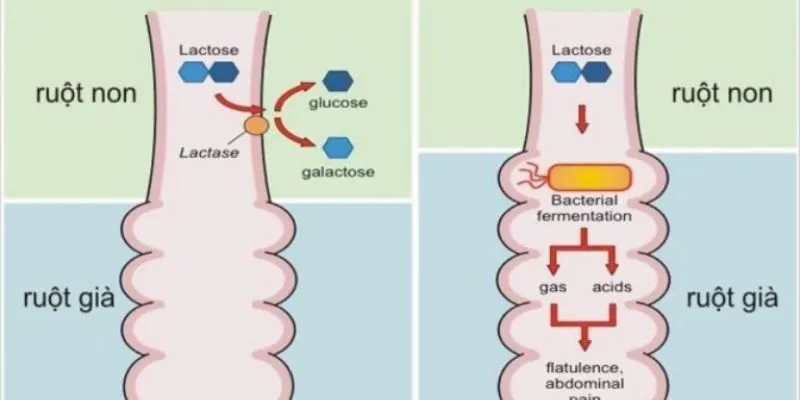 Không dung nạp lactose