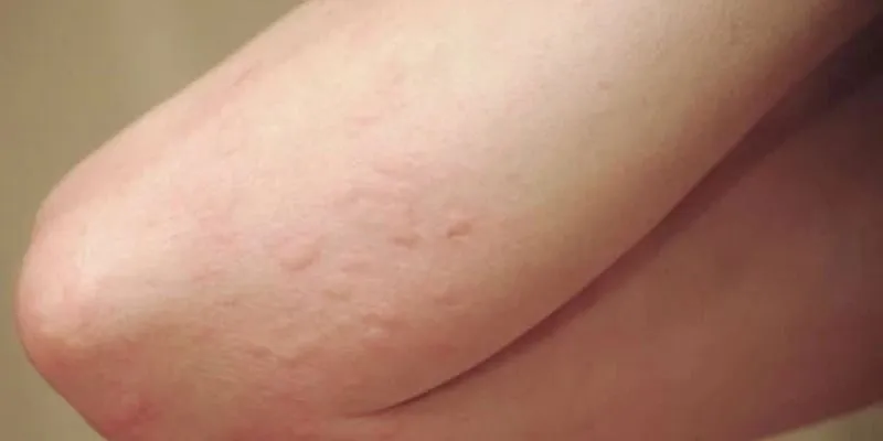 Dị ứng được biểu hiện như thế nào?