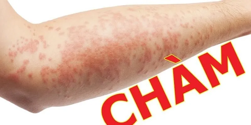 Chàm (eczema) – chẩn đoán và điều trị